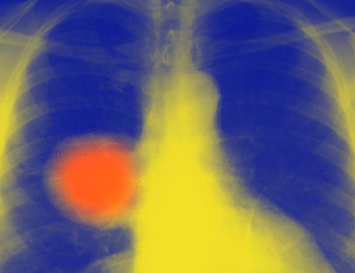 Cancer-associated fibroblasts confer ALK inhibitor resistance in EML4-ALK–driven lung cancer by concurrent integrin and MET signaling | Science Signaling