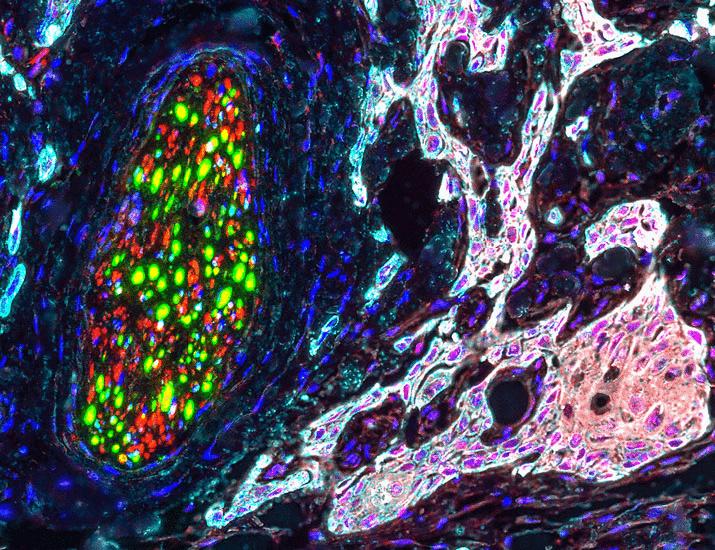 EGFR activation sensitizes trigeminal NMDA receptors to promote pain and morphine analgesic tolerance in oral cancer | Science Signaling