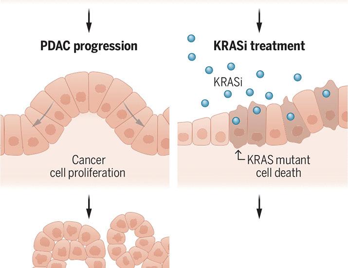 KRAShing pancreatic cancer before takeoff | Science KRAShing pancreatic cancer before takeoff | Science